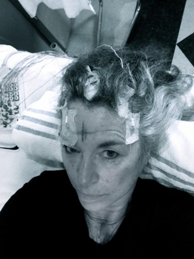 Epilepsy – Up Close & Personal